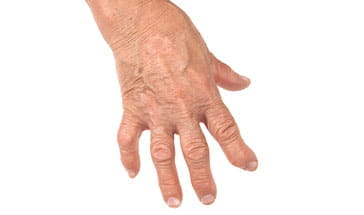 Diagnostic Challenges of Rheumatologic Disease | Pri-Med